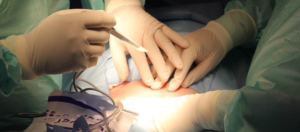 Laser Surgery for Fistula